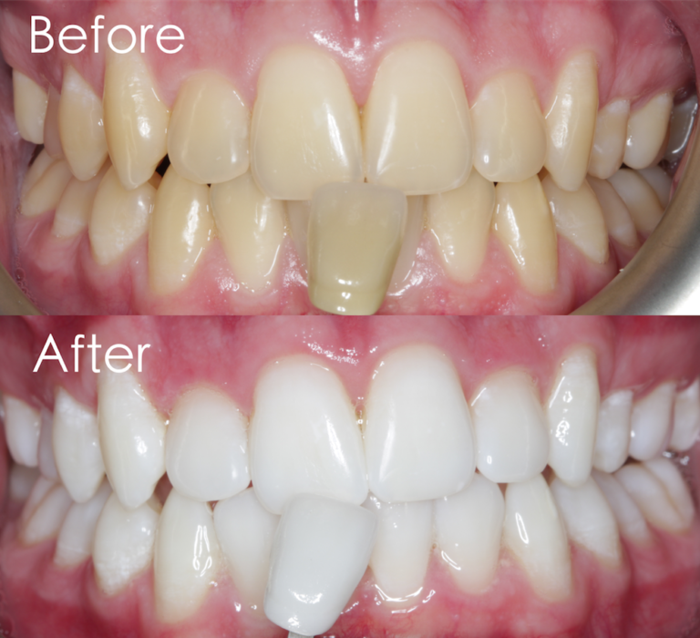Laser Teeth Whitening